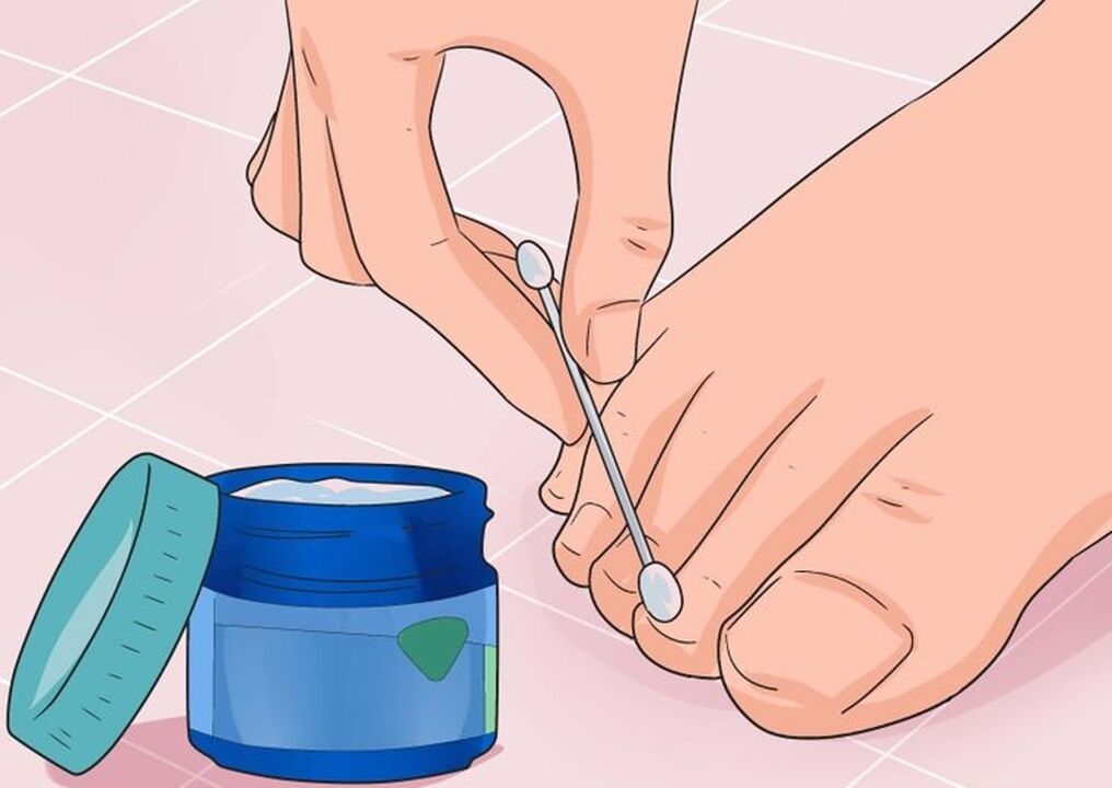 Cure Nail houba