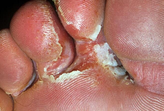 příznaky interdigitální houby